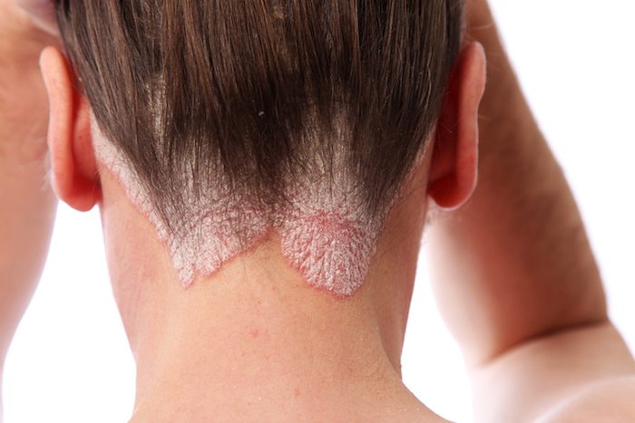 psoriasis scalp 19 beauty products this makeup artist with psoriasis swears by healthista